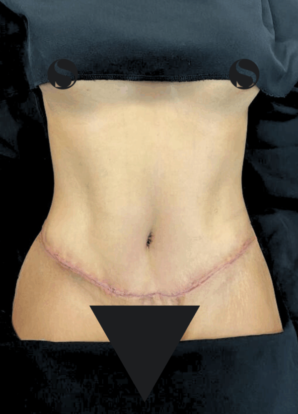 Body Lift- 061025 - Image 3