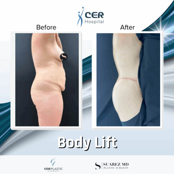 Body Lift -220925 - Image 5