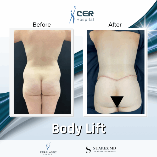 Body Lift -220925 - Image 6