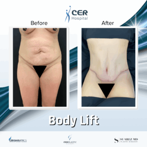 Body Lift -220925