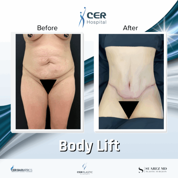 Body Lift -220925