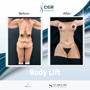 Body Lift – 141125