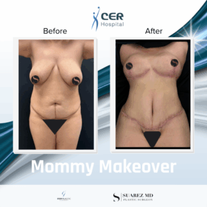 Mommy Makeover – 291025