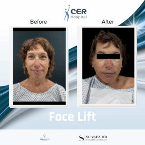Face Lift – 121125