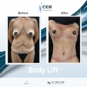 Body Lift – 111225