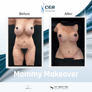 Mommy Makeover – 101125