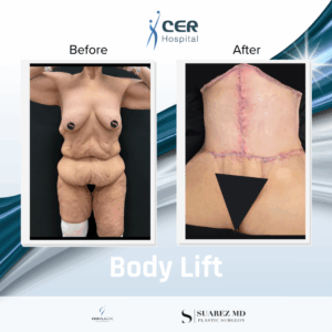 Body Lift – 281125