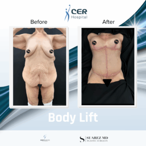 Body Lift – 011225