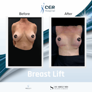 Breast Lift – 021225
