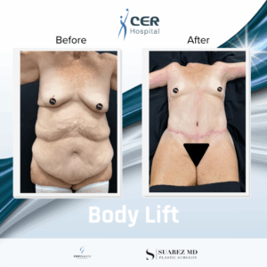 Body Lift – 031225