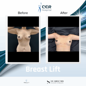Breast Lift – 151225