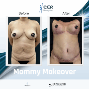 Mommy Makeover – 161225