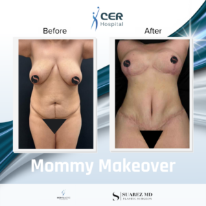 Mommy Makeover – 291025