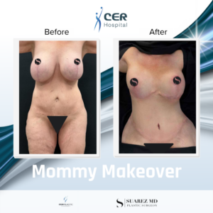 Mommy Makeover – 101125