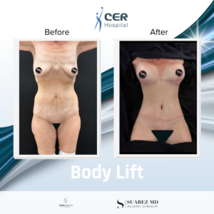 Body Lift – 111125
