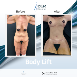 Body Lift – 141125