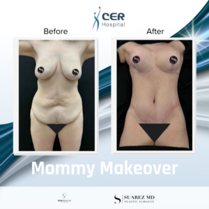 Mommy Makeover – 111225