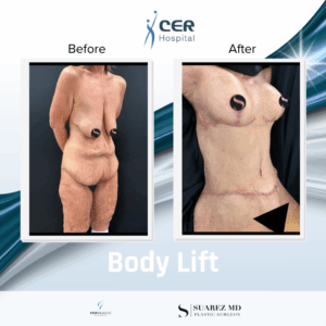 Body Lift – 141125