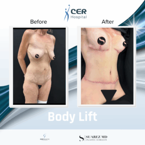 Body Lift – 111125