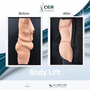 Body Lift – 281125