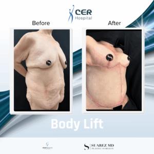 Body Lift – 011225