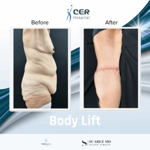 Body Lift – 031225