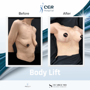 Body Lift – 101225