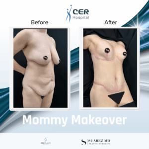 Mommy Makeover – 111225