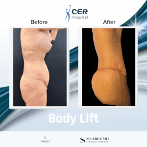 Body Lift – 121225