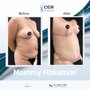 Mommy Makeover – 161225