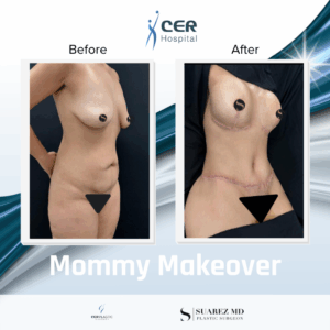 Mommy Makeover – 191225