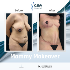 Mommy Makeover – 291025