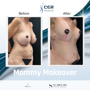 Mommy Makeover – 101125