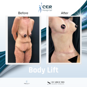 Body Lift – 141125