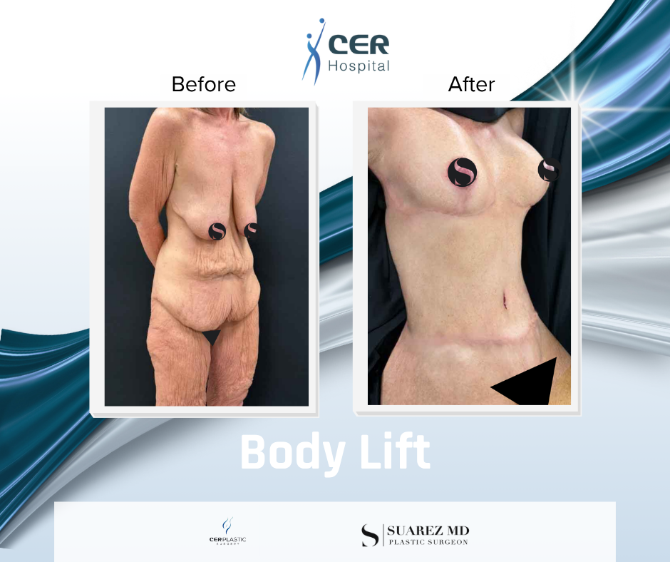 Body Lift - 141125 - Image 2
