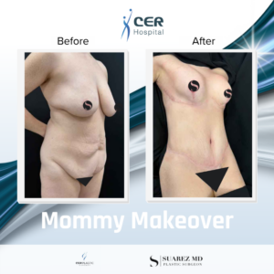 Mommy Makeover – 111225