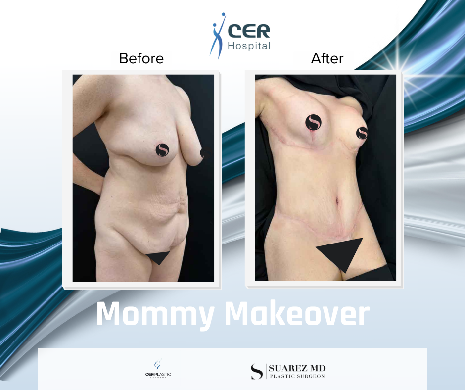 Mommy Makeover - 111225 - Image 2
