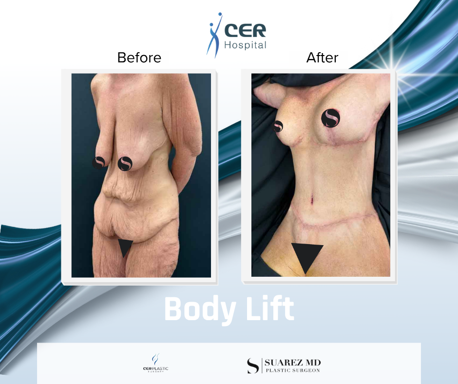 Body Lift - 141125 - Image 3