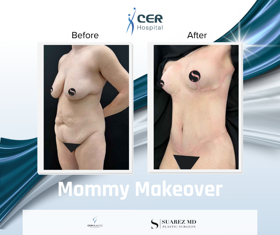 Mommy Makeover - 111225 - Image 3