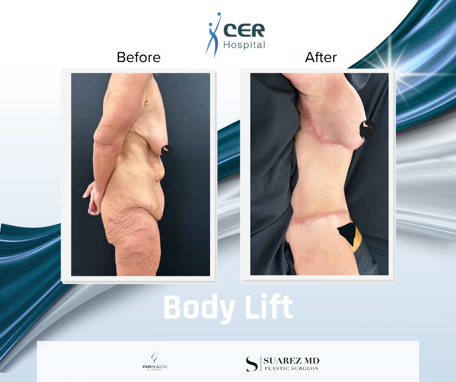 Body Lift - 141125 - Image 4