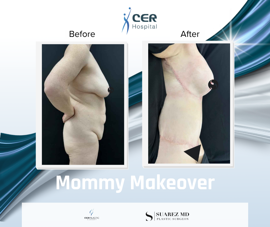 Mommy Makeover - 111225 - Image 4