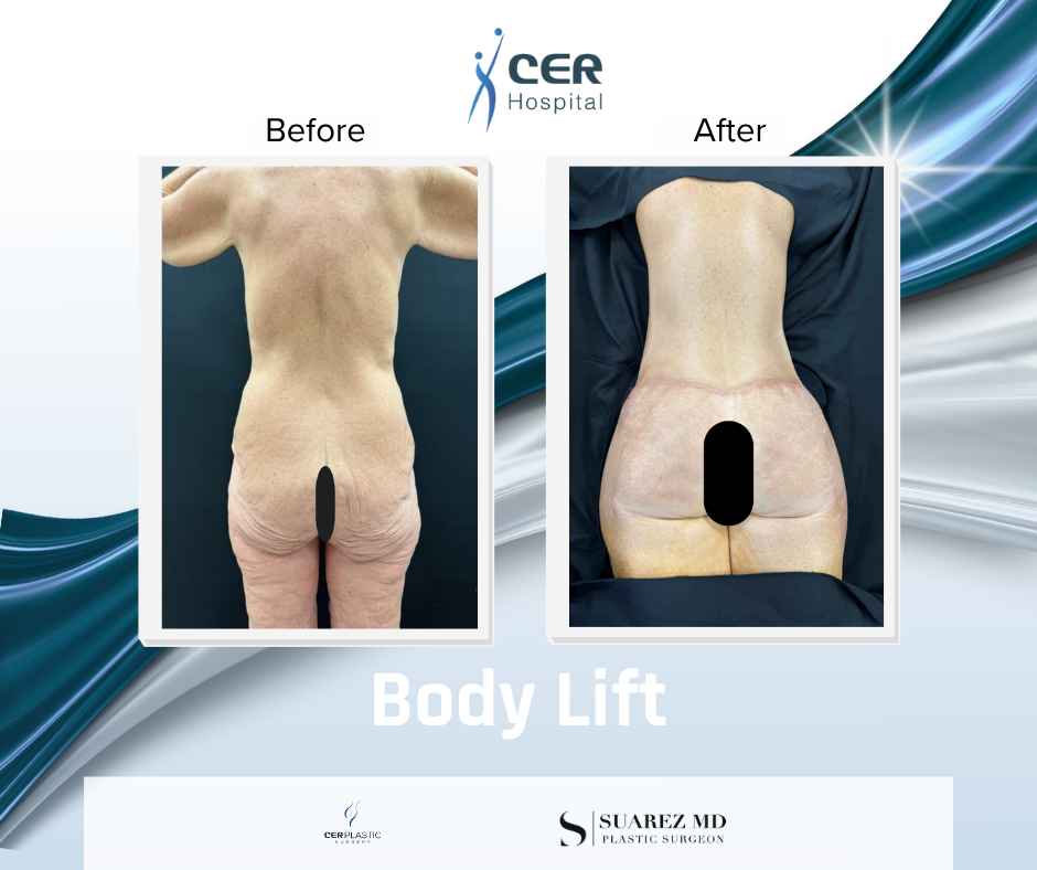 Body Lift - 141125 - Image 5