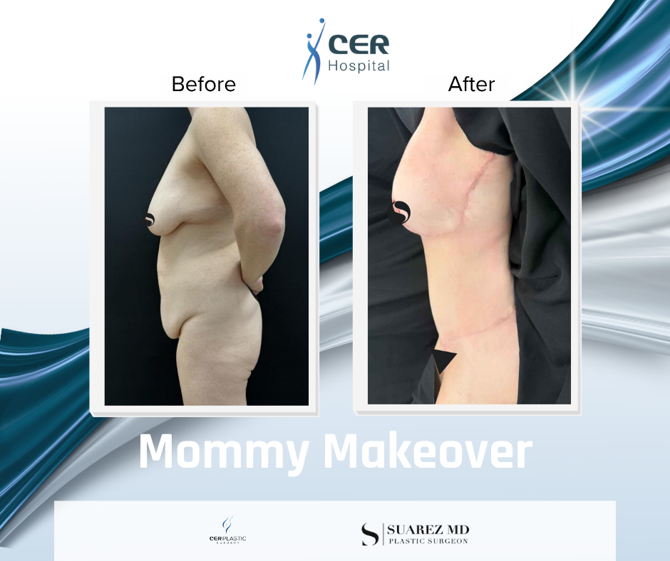 Mommy Makeover - 111225 - Image 5