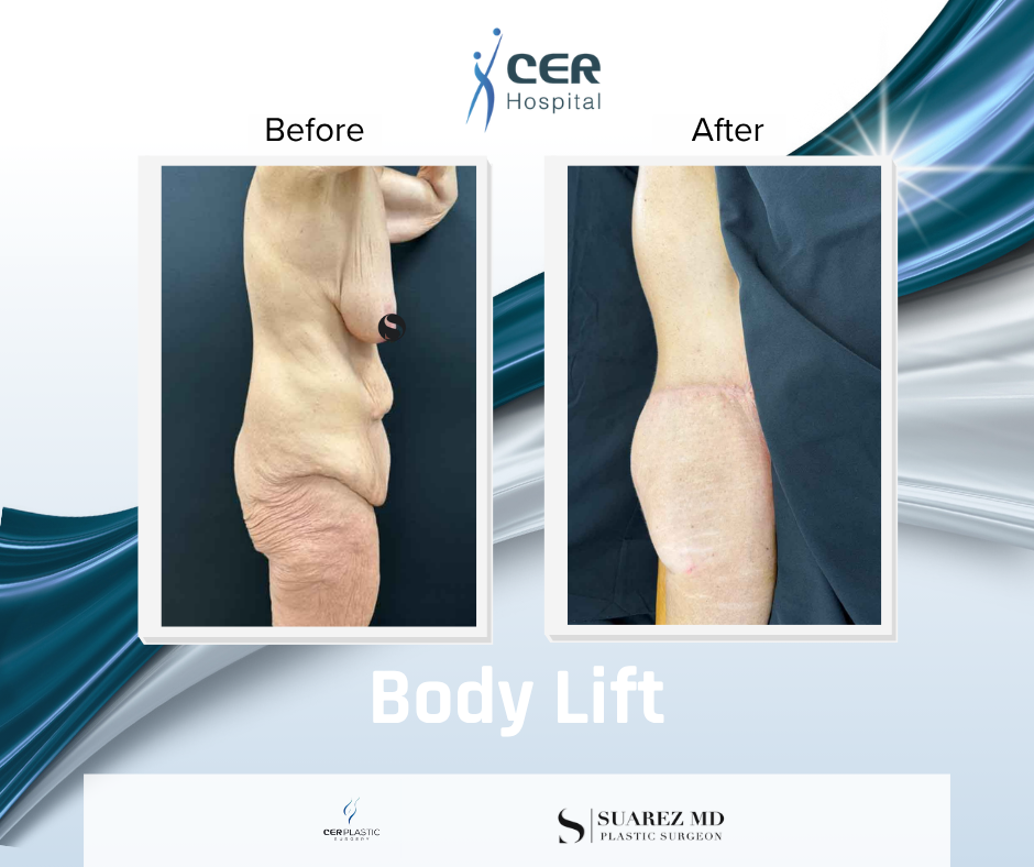 Body Lift - 141125 - Image 6
