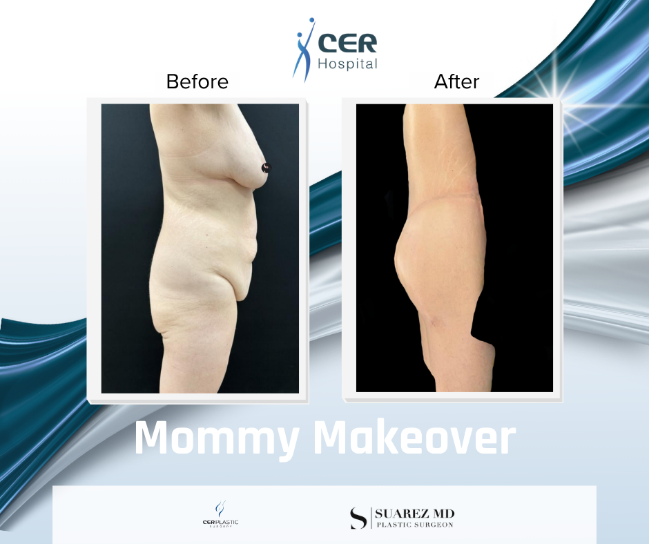 Mommy Makeover - 111225 - Image 6