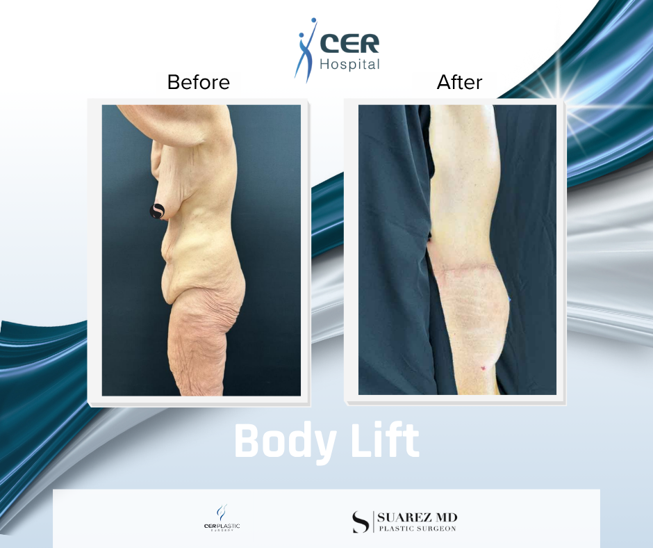 Body Lift - 141125 - Image 7