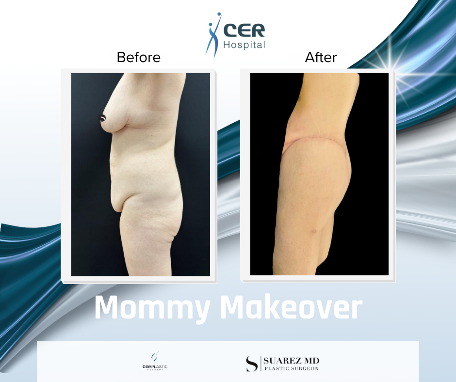Mommy Makeover - 111225 - Image 7