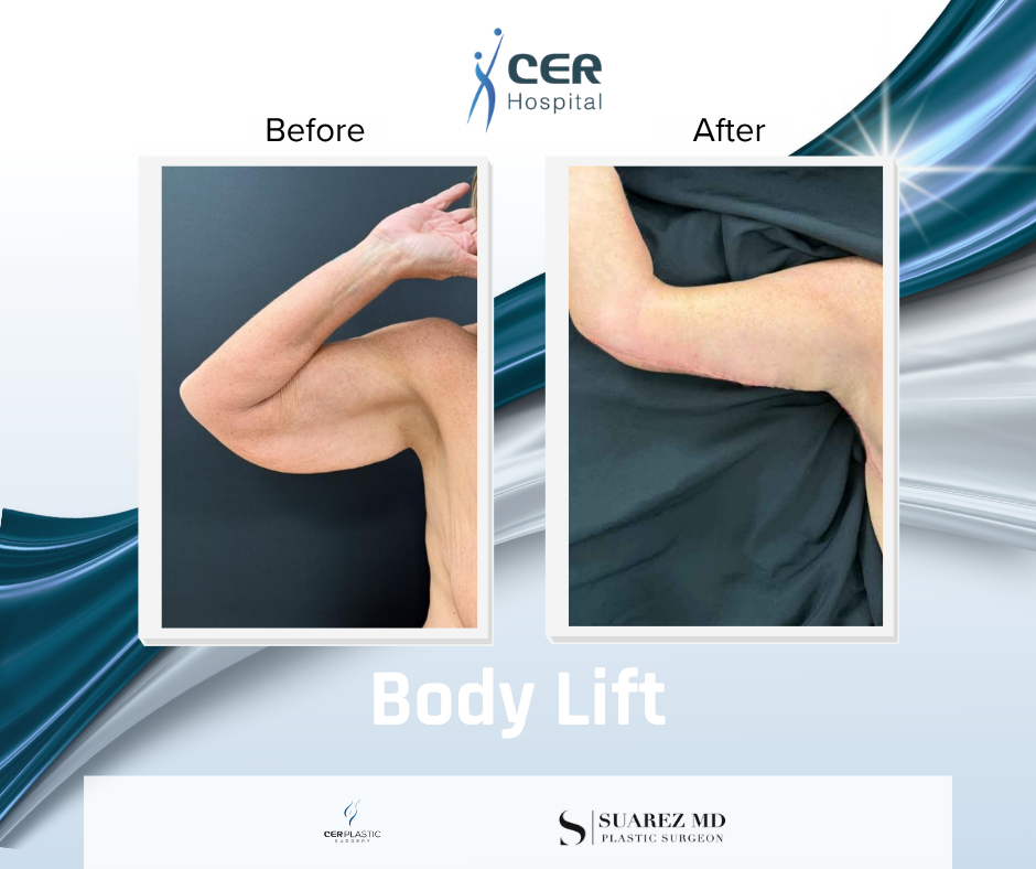 Body Lift - 141125 - Image 8