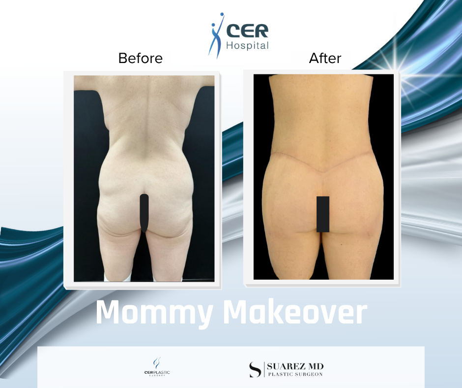 Mommy Makeover - 111225 - Image 8