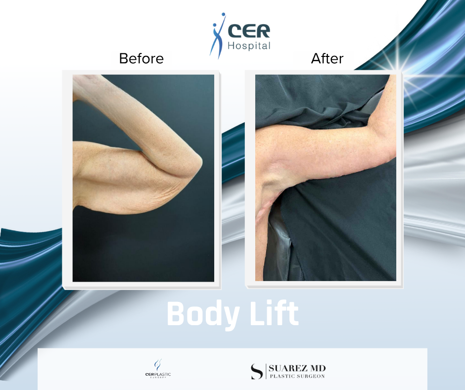 Body Lift - 141125 - Image 9